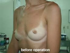 plastic-surgery-breast-augmentation 